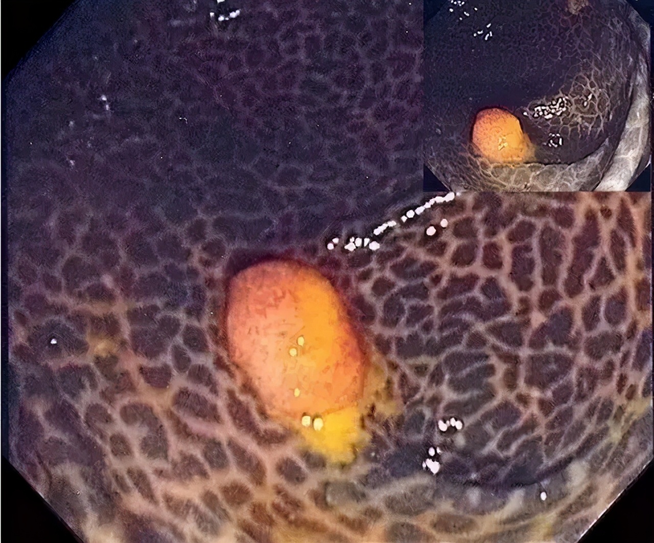 排毒清理肠道垃圾美容又养颜,清宿便排肠毒的骗局