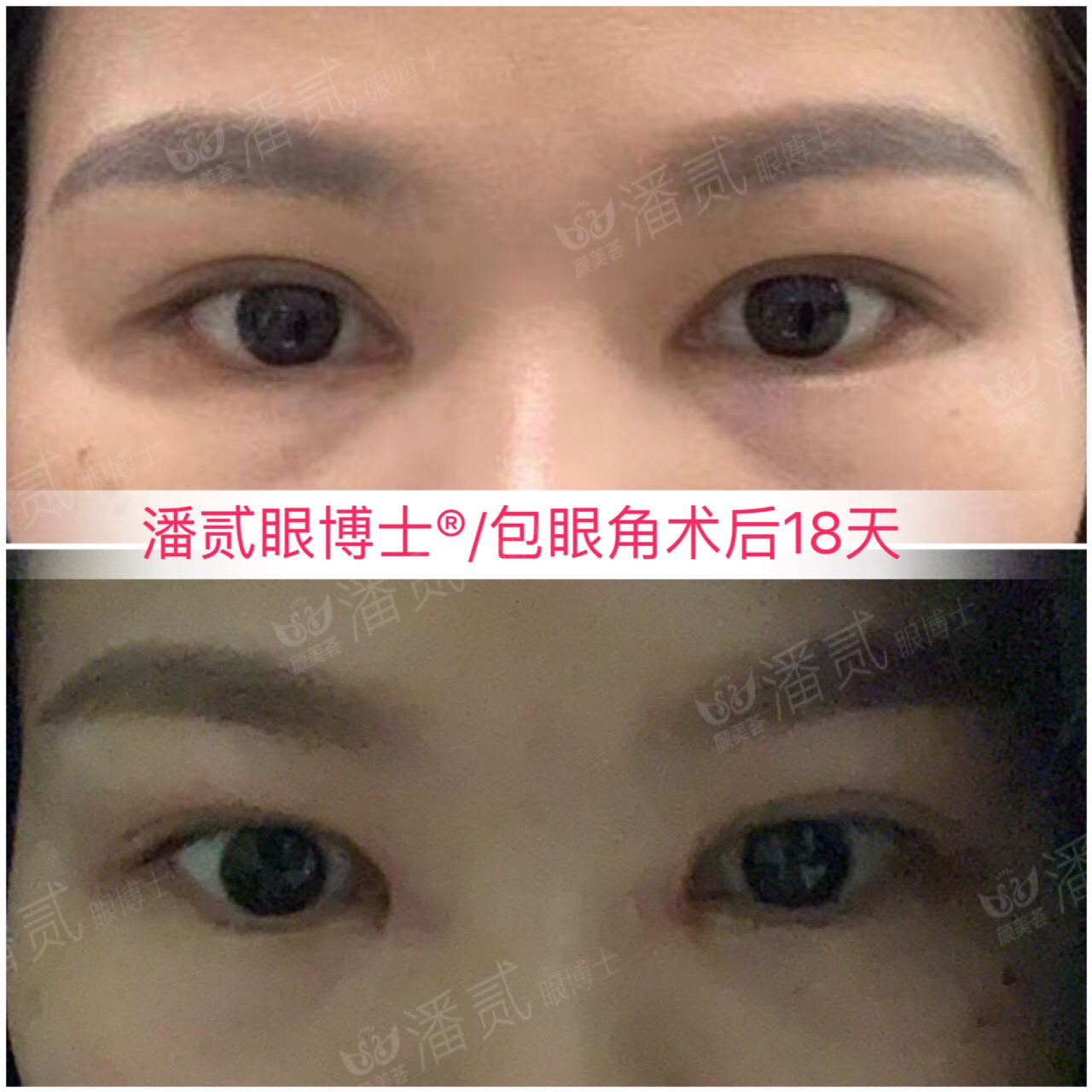 开内眼角会留疤的照片,开内眼角的疤痕变白色了怎么办