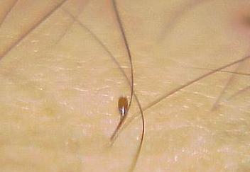 辟谣:带安全套就能预防所有性病吗?错,这种性病戴避孕套也没法