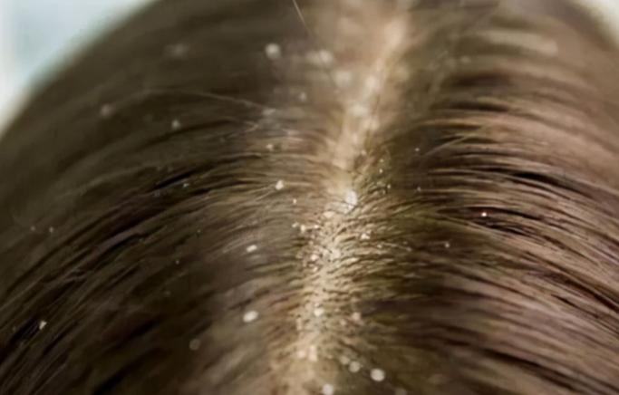 头皮长小疙瘩抠破有脓怎么办,头皮长了个疙瘩破了怎么办