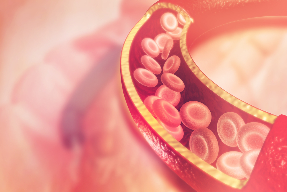 颈动脉斑块超过50%容易得脑梗吗,有颈动脉斑块怎样处理才不得脑梗