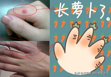 冬天冻疮又痛又痒用什么药喷最好,冻疮又疼又痒怎么缓解