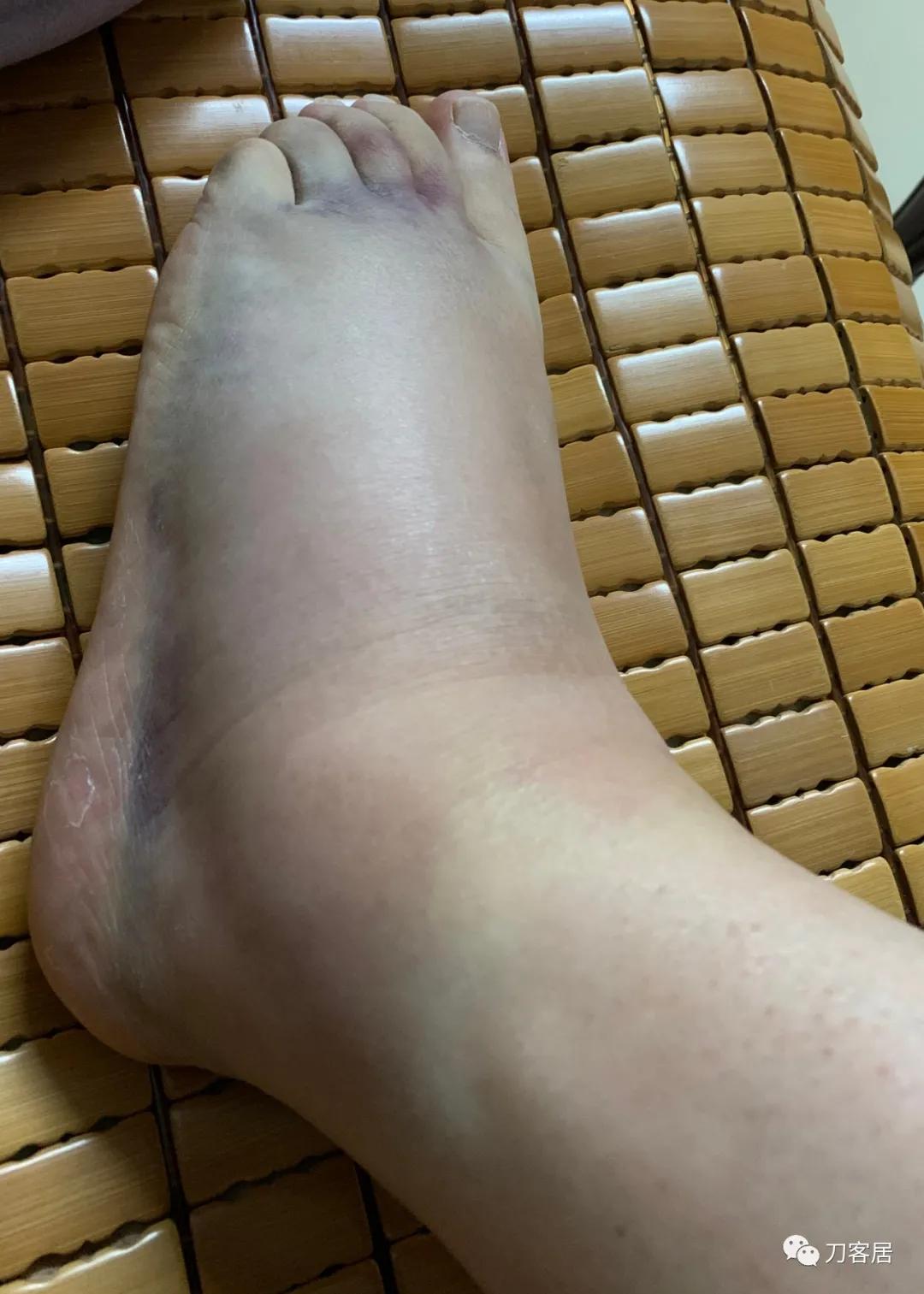 三种扭伤急救的最佳方法,治疗脚踝扭伤的膏药哪种好