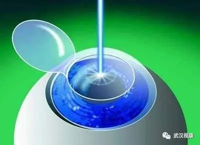 近视眼手术的发展史动画,近视眼手术发展史图片