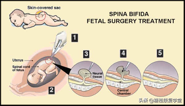 后背脊柱中间凸是正常的吗,脊柱裂腰左侧凸起是怎么回事