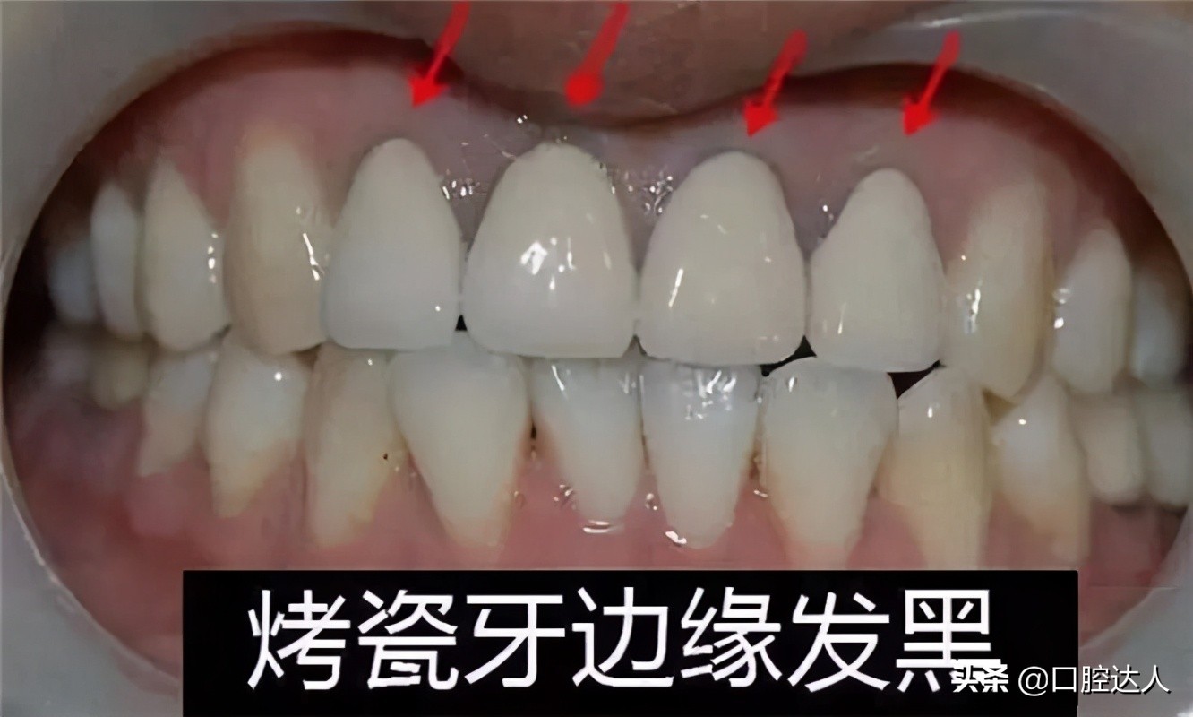 烤瓷牙里面的真牙烂了怎么办,怎么知道烤瓷牙里面的牙有没有烂