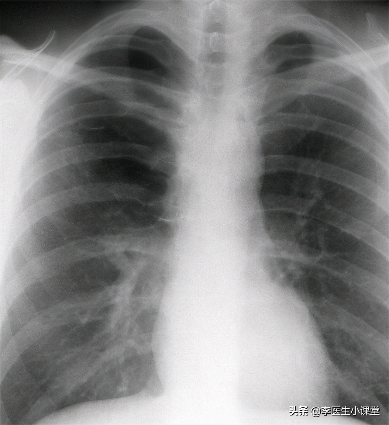 戒烟后黑肺能变原样吗,戒烟后原本黑的肺会好吗