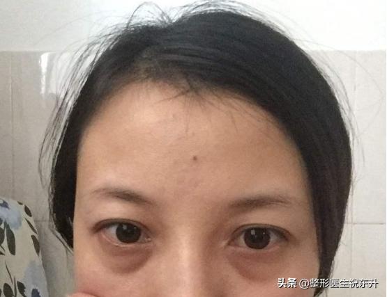 做眼袋用什么护肤品,眼袋大怎么办用什么眼霜好