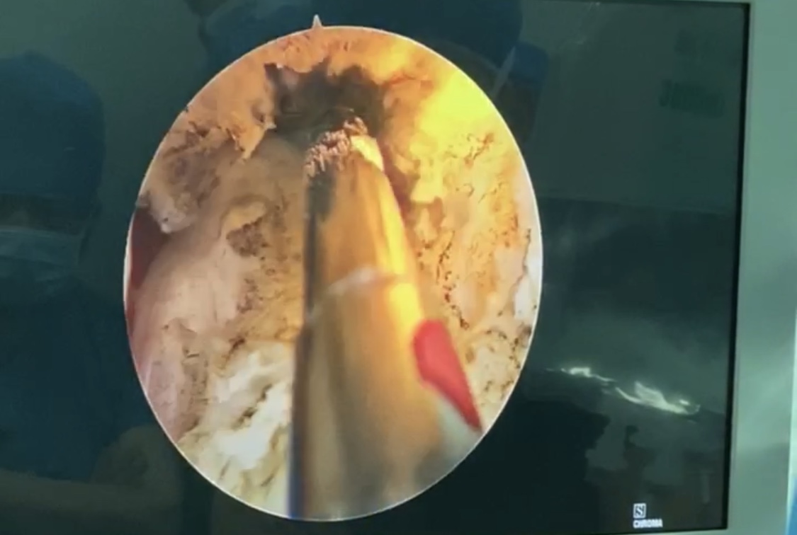 治疗前列腺增生什么方法最靠谱,前列腺增生何种方式治疗效果最好