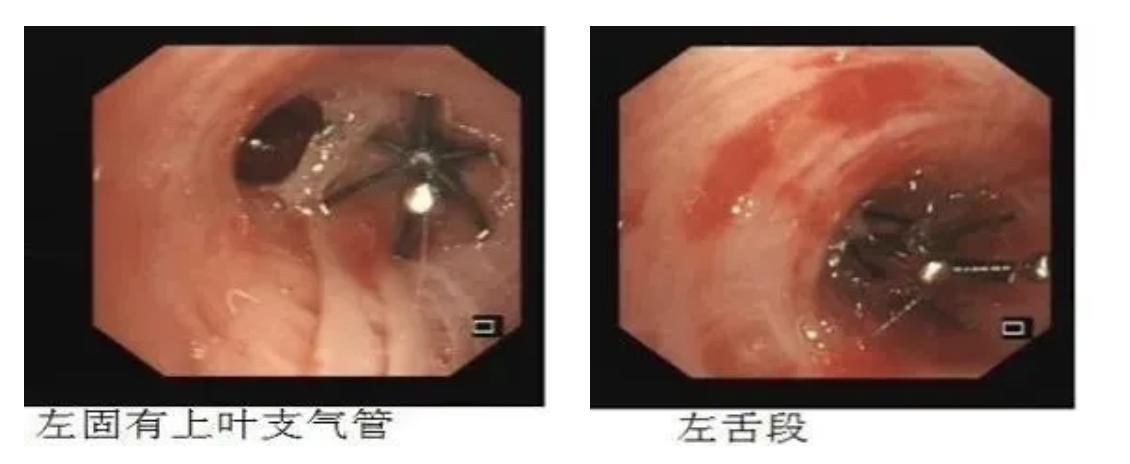 慢阻肺是桶状胸,慢阻肺会出现桶状肺吗