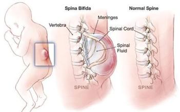 隐性脊柱裂小凹需要手术吗,隐性脊柱裂需要检查什么