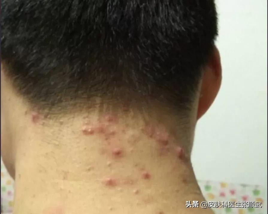 后脑勺毛囊炎疙瘩涂什么药,后脑勺耳朵位置长疙瘩毛囊炎