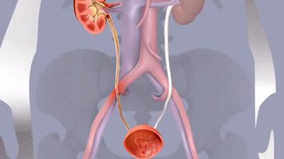 尿路结石知识,尿路结石影像