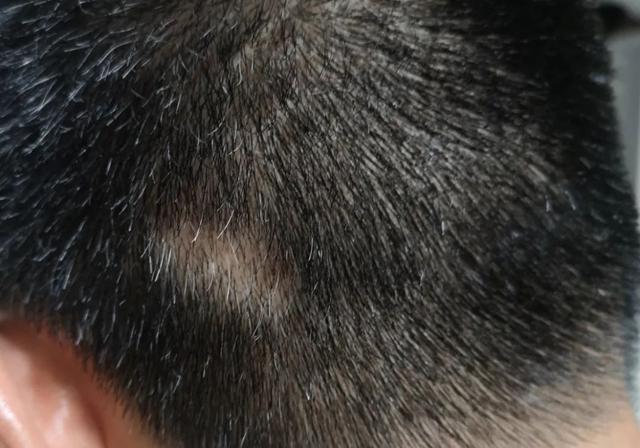 病理性脱发,偏执性脱发