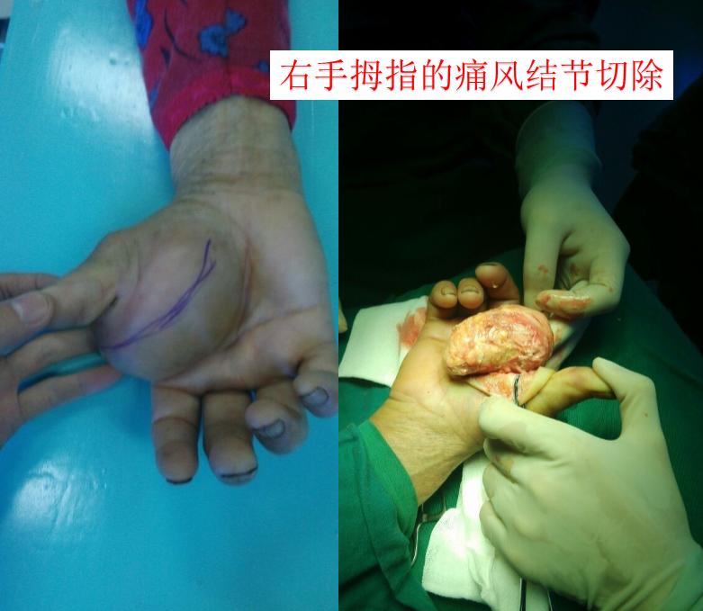 发作一次痛风诊断痛风性关节炎,痛风性关节炎和痛风哪个最严重