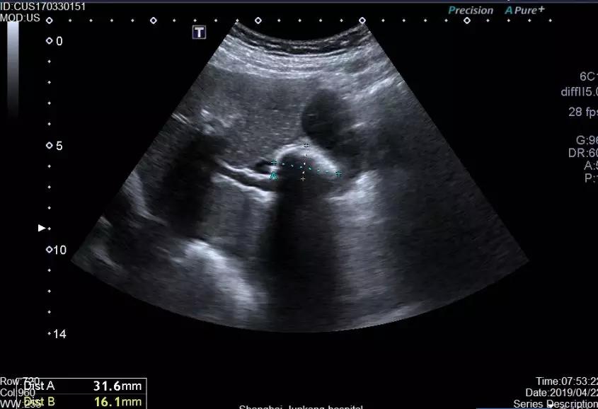 胆结石应注意些什么事项,胆结石怎样消除