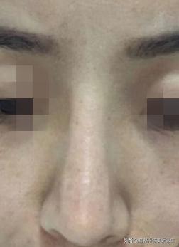 塌鼻子怎么能变成尖鼻子,鼻子太窄太小是不是很难增高鼻梁