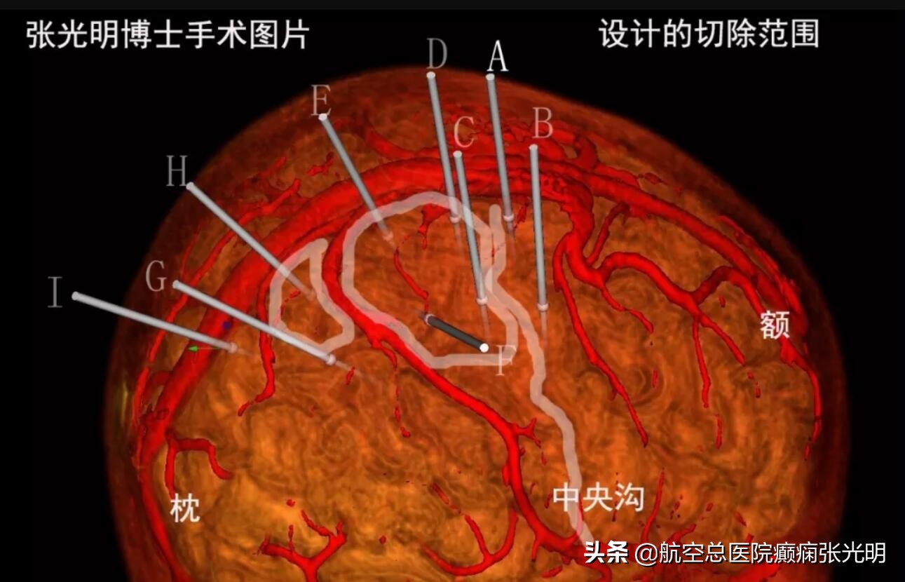 用四种方法癫痫几乎可以控制,彻底治愈癫痫的最好药