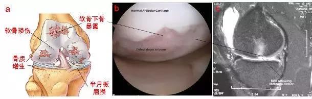 滑膜炎是不是炎症,骨质增生膝盖疼痛膝盖积液滑膜炎
