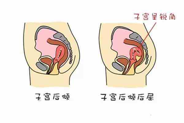 子宫位置会影响受孕?妇产医生授你怀孕秘籍