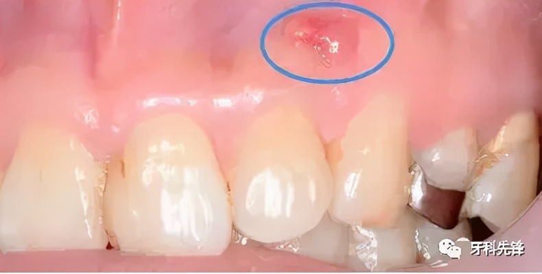 牙龈上长个脓包能把它戳破吗,牙龈上长脓包敢不敢自己戳破