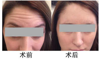 什么是热玛吉除皱术千万别入坑,什么是热玛吉整形项目