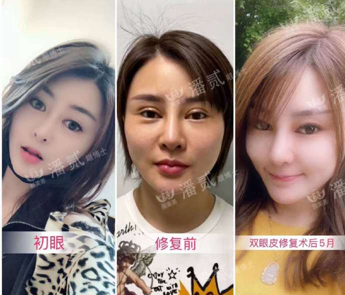 双眼皮离眉毛太近还能修复好吗,割双眼皮眉毛下面肿会消肿吗