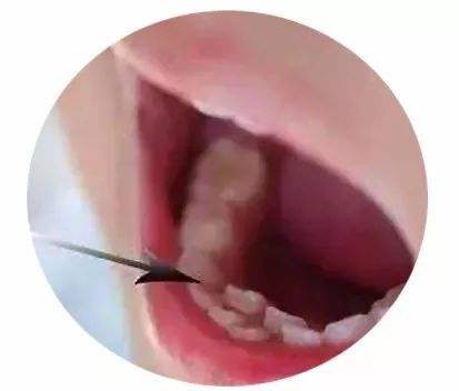 6岁小孩长出双排牙是不是龅牙,孩子长出双排牙只因父母爱太多