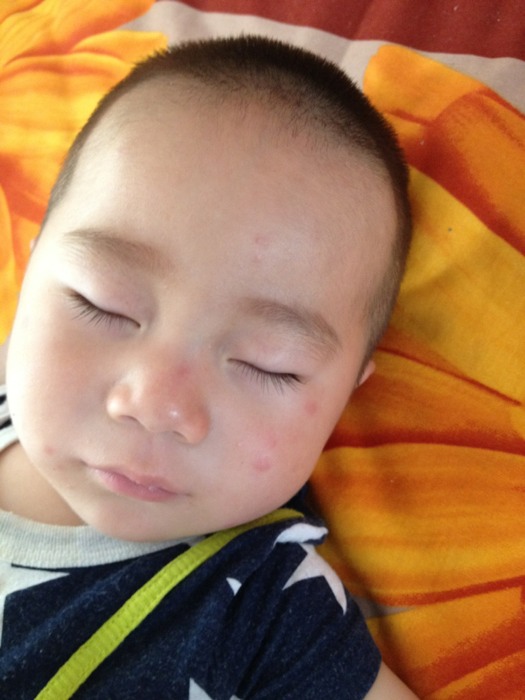 蚊虫叮咬过敏没药怎么快速止痒,防蚊虫叮咬止痒药水