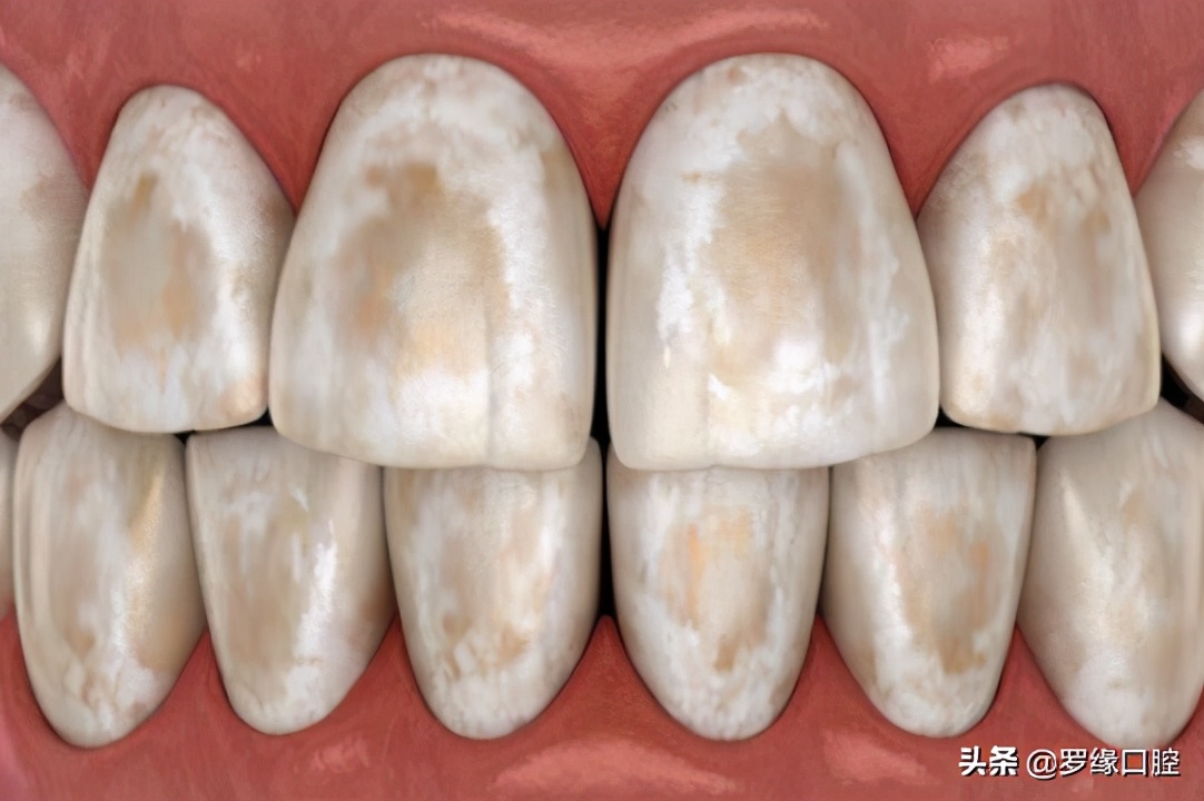 牙齿矫正后变黄怎么处理,矫正牙齿后牙齿为什么变黄了