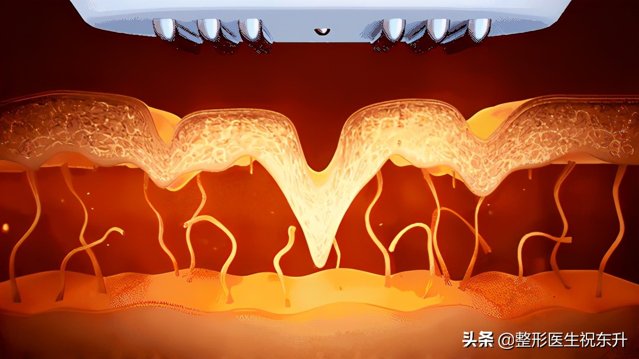 热玛吉有必要指定医生做吗,为什么不建议做热玛吉