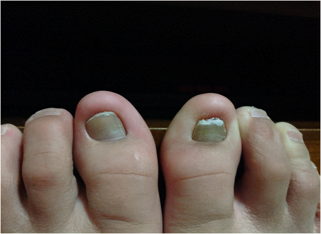 说说灰指甲那些事,大家说说灰指甲是怎么治好的