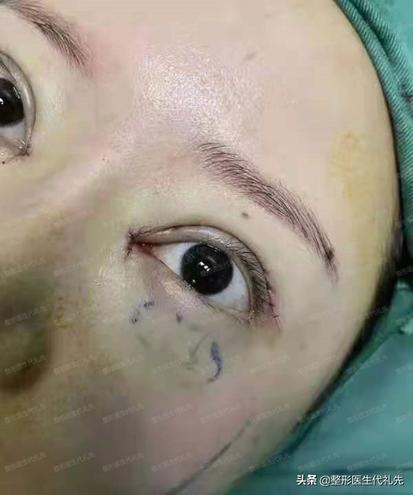 眼综合眼袋手术恢复全过程,眼周年轻化和祛眼袋