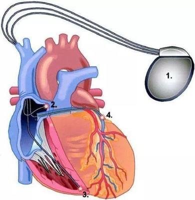 心脏完全性左束支传导阻滞危险吗,完全性左束支传导阻滞是心脏病吗