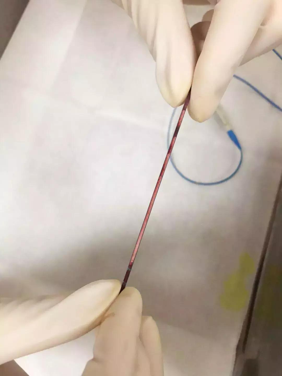 picc发生堵管时的处理方法,picc内置管堵了是什么原因