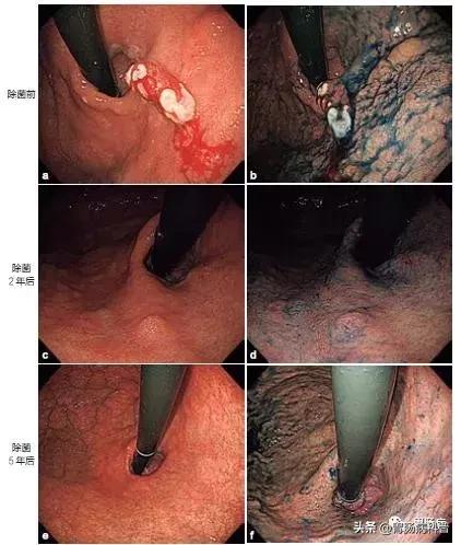 胃增生性肠息肉严重吗,胃体增生性的息肉是什么意思
