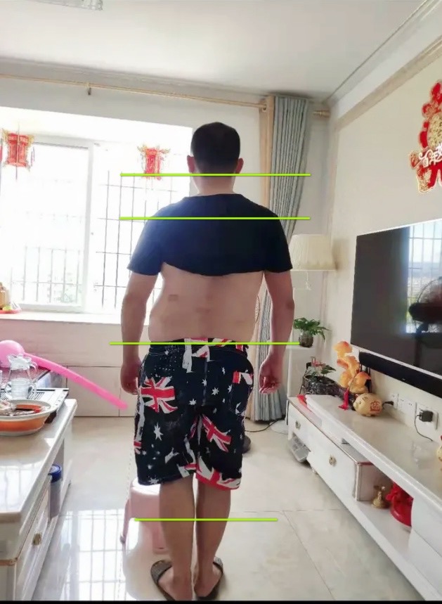 腰椎间盘膨出侧弯疼,腰椎间盘突出脊柱侧弯锻炼方法