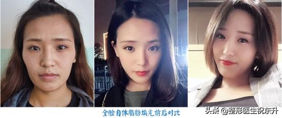 面部脂肪填充一个月皮肤的变化,面部脂肪填充的后脸部真的好了吗