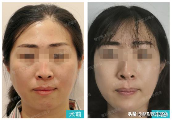 垫下巴手术流程,垫下巴手术的全过程