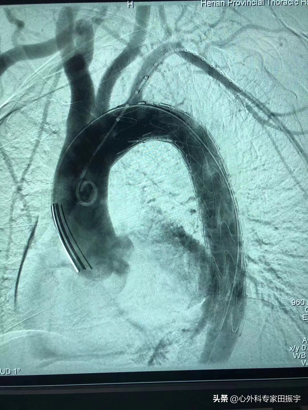胸主动脉瘤最常见的护理措施,胸主动脉疾病