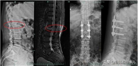 老人摔小腿骨折要手术吗,老年人腰椎压缩性骨折需住院多久