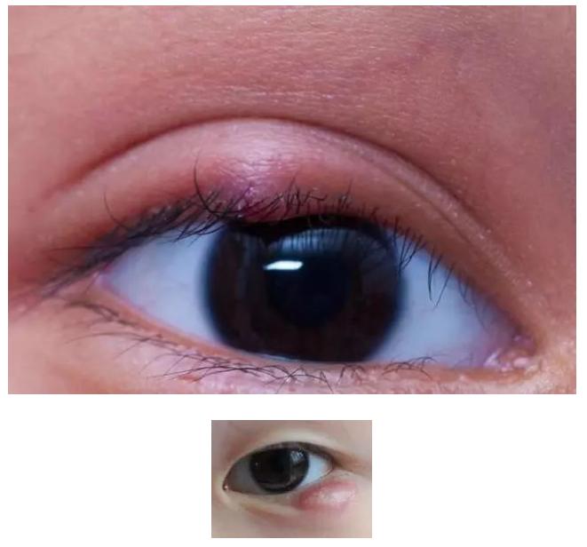 眼睛上长个小疙瘩怎么回事,小朋友眼睛里面长个小疙瘩