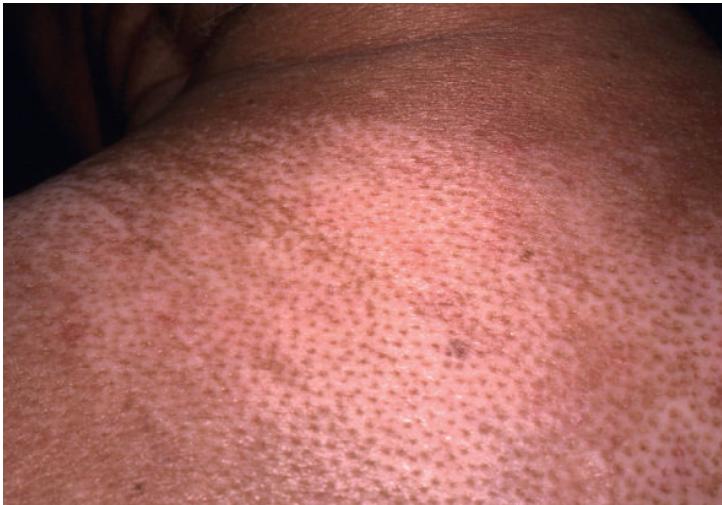 多发性硬化症和系统性硬皮病,系统性硬皮病有什么症状