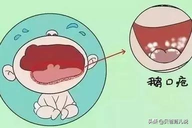 鹅口疮初期的患儿首要护理诊断,月子里宝宝鹅口疮怎么护理