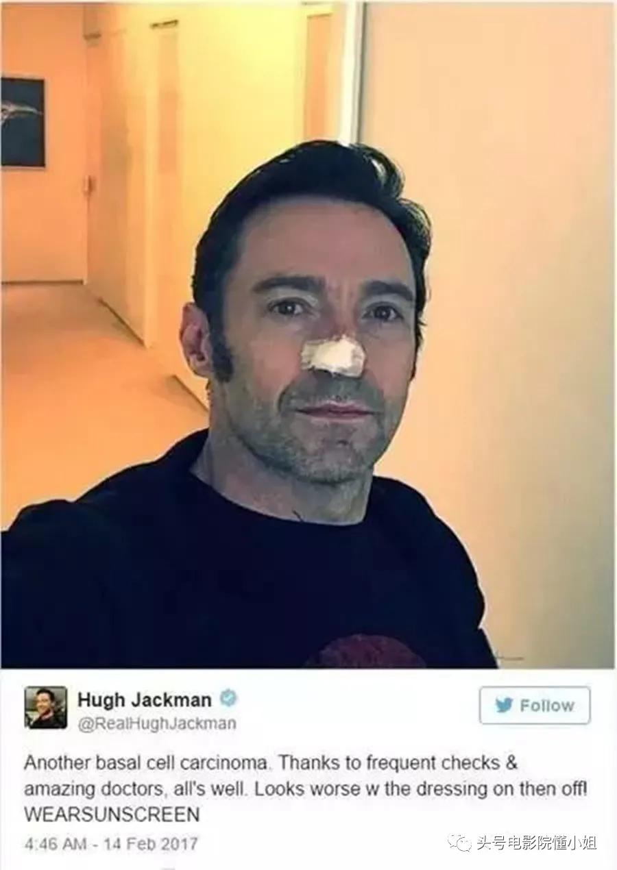 金刚狼爆皮肤癌危机！53岁休杰克曼提醒抹防晒霜，4年前曾动手术