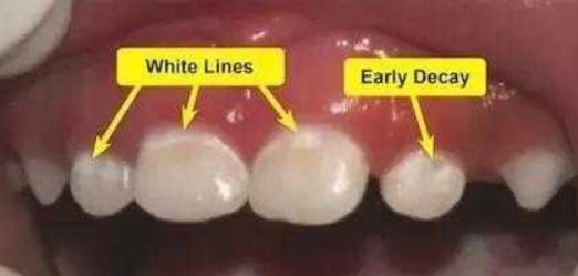 牙齿有白斑是什么原因怎么治疗,牙齿有白斑是什么原因怎么修复