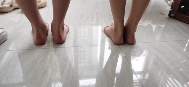 治疗足外翻哪家医院好,什么是足外翻与足内翻