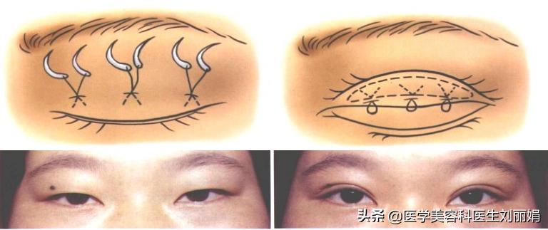 尚雯婕单眼皮吗,尚雯婕参加王牌视频