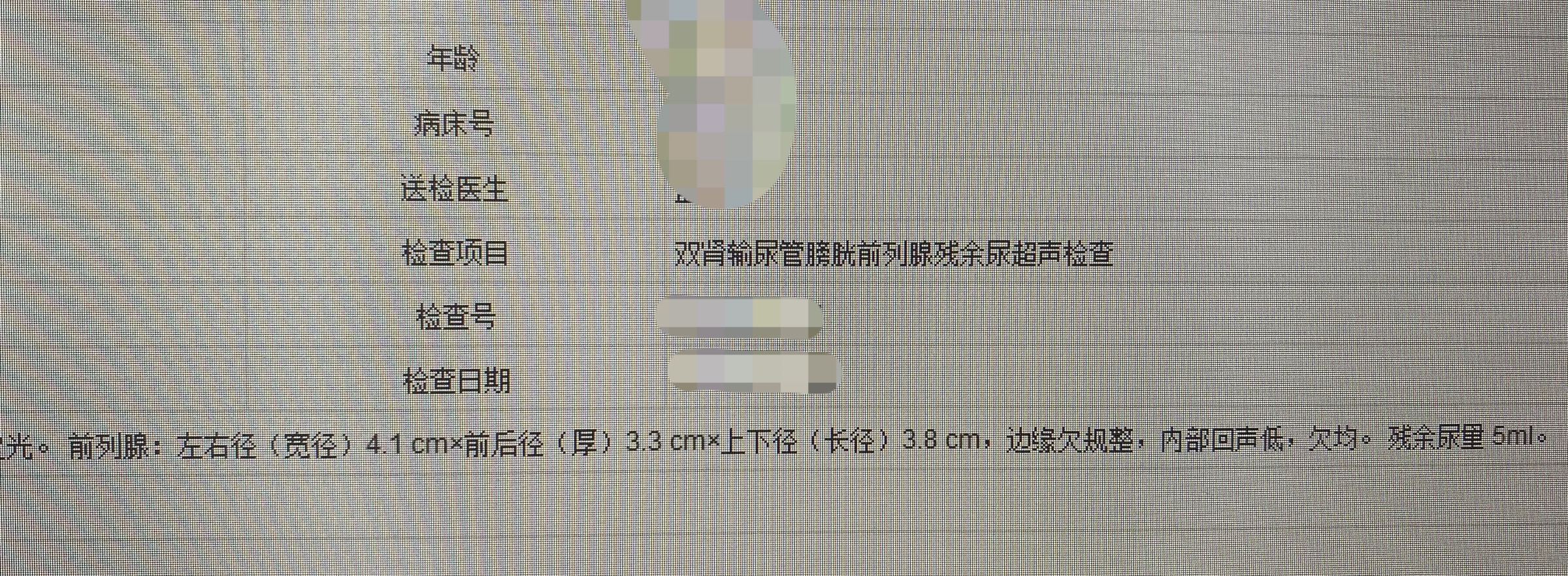 良性前列腺增生最早出现的症状是,彩超提示前列腺增生是前列腺癌吗