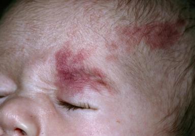 光动力治疗血管瘤的后期护理,血管瘤局部注射治疗效果如何